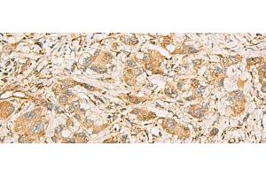 Immunohistochemistry of paraffin-embedded Human liver cancer tissue using MRPS35 Polyclonal Antibody at dilution of 1:60(x200) (MRPS35 anticorps)