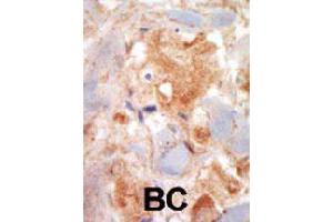 Formalin-fixed and paraffin-embedded human cancer tissue reacted with KIT polyclonal antibody  , which was peroxidase-conjugated to the secondary antibody, followed by DAB staining. (KIT anticorps  (N-Term))