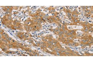 Immunohistochemistry of paraffin-embedded Human gastic cancer using ARHGEF7 Polyclonal Antibody at dilution of 1:40 (ARHGEF7 anticorps)