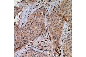 Immunohistochemical analysis of UBE2G1 staining in human breast cancer formalin fixed paraffin embedded tissue section.
