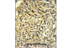 FKBP14 Antibody (N-term) (ABIN390491 and ABIN2840850) IHC analysis in formalin fixed and paraffin embedded human Lung carcinoma followed by peroxidase conjugation of the secondary antibody and DAB staining. (FKBP14 anticorps  (N-Term))