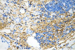 Immunohistochemistry was performed on paraffin-embedded human renal carcinoma using oxoglutarate receptor 1 antibody (ABIN7799714), 1:200). (Recombinant OXGR1 anticorps)