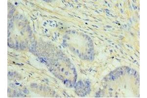 Immunohistochemistry of paraffin-embedded human colon cancer using ABIN7148434 at dilution of 1:100 (NCAPH anticorps  (AA 1-250))