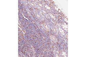 Immunohistochemical analysis of C on paraffin-embedded Human colon carcinoma tissue. (Glucuronidase beta anticorps  (AA 335-362))