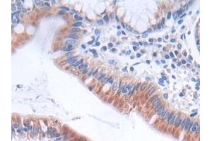 Detection of GLTP in Human Stomach cancer Tissue using Polyclonal Antibody to Glycolipid Transfer Protein (GLTP)