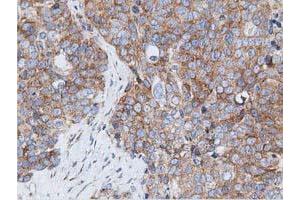 Immunohistochemical staining of paraffin-embedded Adenocarcinoma of Human ovary tissue using anti-RIT2 mouse monoclonal antibody.