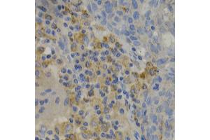 Immunohistochemistry of paraffin-embedded human lung cancer using PAK1 Antibody. (PAK1 anticorps)