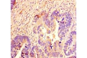Immunohistochemistry of paraffin-embedded human ovarian cancer using ABIN7168711 at dilution of 1:100 (SCG2 anticorps  (AA 31-617))
