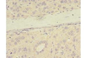 Immunohistochemistry of paraffin-embedded human liver cancer using ABIN7165968 at dilution of 1:100