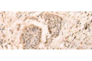 Immunohistochemistry of paraffin-embedded Human esophagus cancer tissue using ELP4 Polyclonal Antibody at dilution of 1:25(x200) (ELP4 anticorps)