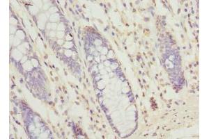Immunohistochemistry of paraffin-embedded human colon cancer using SEC61G Antibody at a dilution of 1:100 (SEC61G anticorps  (AA 1-32))