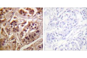 Peptide - +Immunohistochemistry analysis of paraffin-embedded human breast carcinoma tissue using GRF-1 antibody. (GRLF1 anticorps)