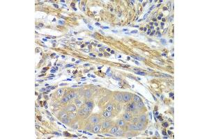 Immunohistochemistry of paraffin-embedded human gastric cancer using PICK1 antibody at dilution of 1:100 (x40 lens). (PICK1 anticorps)