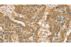 Immunohistochemistry of paraffin-embedded Human thyroid cancer using PSMC1 Polyclonal Antibody at dilution of 1:40 (PSMC1 anticorps)