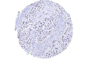 Distinct nucleolar immunostaining in the nucleoli of an esophageal squamous cell carcinoma (Recombinant Nucleolin anticorps)