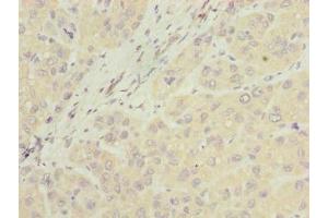 Immunohistochemistry of paraffin-embedded human liver cancer using ABIN7157067 at dilution of 1:100
