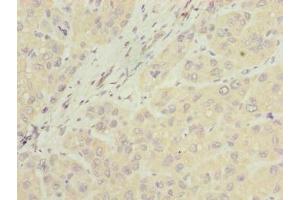 Immunohistochemistry of paraffin-embedded human liver cancer using ABIN7157067 at dilution of 1:100 (NUBPL anticorps  (AA 39-319))
