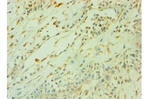 Immunohistochemistry of paraffin-embedded human breast cancer using ABIN7160470 at dilution of 1:100