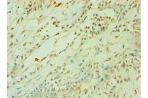 Immunohistochemistry of paraffin-embedded human breast cancer using ABIN7160470 at dilution of 1:100 (CD33 anticorps  (AA 49-259))