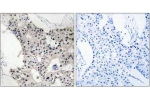 Immunohistochemistry analysis of paraffin-embedded human breast carcinoma, using BAGE4 Antibody.