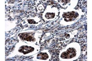 IHC-P Image TSPYL1 antibody detects TSPYL1 protein at nucleus in human breast cancer by immunohistochemical analysis. (TSPYL1 anticorps)