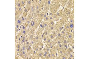 Immunohistochemistry of paraffin-embedded human liver damage using PEX5 antibody (ABIN6133015, ABIN6145469, ABIN6145471 and ABIN6221464) at dilution of 1:100 (40x lens). (PEX5 anticorps  (AA 1-260))