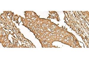 Immunohistochemistry of paraffin-embedded Human colorectal cancer tissue using UBE2A Polyclonal Antibody at dilution of 1:45(x200) (UBE2A anticorps)