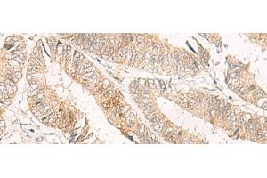 Immunohistochemistry of paraffin-embedded Human colorectal cancer tissue using TRAPPC1 Polyclonal Antibody at dilution of 1:50(x200) (TRAPPC1 anticorps)