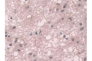 IHC-P analysis of Human Glioma Tissue, with DAB staining. (TKT anticorps  (AA 1-294))