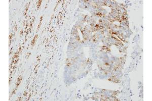 IHC-P Image Immunohistochemical analysis of paraffin-embedded OVCA xenograft, using Monoamine Oxidase B, antibody at 1:100 dilution.