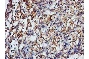 Immunohistochemical staining of paraffin-embedded Carcinoma of Human kidney tissue using anti-TUBAL3 mouse monoclonal antibody. (TUBAL3 anticorps  (AA 150-446))