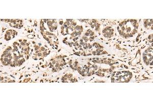 Immunohistochemistry of paraffin-embedded Human esophagus cancer tissue using BRD7 Polyclonal Antibody at dilution of 1:50(x200) (BRD7 anticorps)