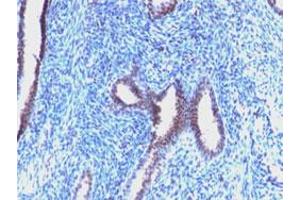 Immunohistochemical staining (Formalin-fixed paraffin-embedded sections) of human endometrial carcinoma with CCNB1 monoclonal antibody, clone CCNB1/1098 .