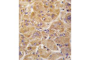 Formalin-fixed and paraffin-embedded human hepatocarcinoma tissue reacted with ALDH1A1 antibody , which was peroxidase-conjugated to the secondary antibody, followed by DAB staining. (ALDH1A1 anticorps  (AA 302-331))