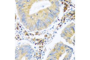 Immunohistochemistry of paraffin-embedded human colon carcinoma using MANF antibody at dilution of 1:100 (40x lens). (MANF anticorps)