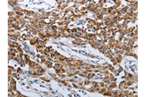 The image on the left is immunohistochemistry of paraffin-embedded Human lung cancer tissue using ABIN7192612(SPAG1 Antibody) at dilution 1/25, on the right is treated with synthetic peptide.