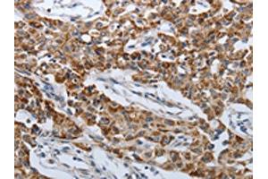 The image on the left is immunohistochemistry of paraffin-embedded Human lung cancer tissue using ABIN7192612(SPAG1 Antibody) at dilution 1/25, on the right is treated with synthetic peptide. (SPAG1 anticorps)