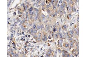 ABIN6266778 at 1/100 staining human ovarian cancer tissue sections by IHC-P. (Fibrillin 1 anticorps  (C-Term))