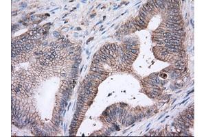 Immunohistochemical staining of paraffin-embedded Adenocarcinoma of Human ovary tissue using anti-BSG mouse monoclonal antibody. (CD147 anticorps)