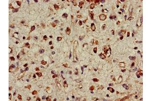 IHC image of ABIN7142234 diluted at 1:500 and staining in paraffin-embedded human glioma performed on a Leica BondTM system. (PSMC4 anticorps  (Regulatory Subunit 6B))