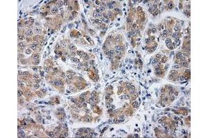 Immunohistochemical staining of paraffin-embedded Carcinoma of liver tissue using anti-PLEK mouse monoclonal antibody. (Pleckstrin anticorps)