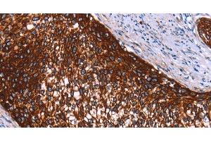 Immunohistochemistry of paraffin-embedded Human cervical cancer using HMGCS2 Polyclonal Antibody at dilution of 1:40 (HMGCS2 anticorps)