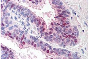 Human Prostate (formalin-fixed, paraffin-embedded) stained with TARBP1 antibody ABIN214523 at 5 ug/ml followed by biotinylated goat anti-rabbit IgG secondary antibody ABIN481713, alkaline phosphatase-streptavidin and chromogen. (TARBP1 anticorps  (Internal Region))