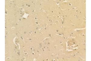ABIN6262417 and ABIN6277679 at 1/100 staining human glioblastoma by IHC-P.