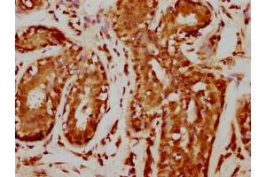 IHC image of nforHU diluted at 1:20 and staining in paraffin-embedded human breast cancer performed on a Leica BondTM system.