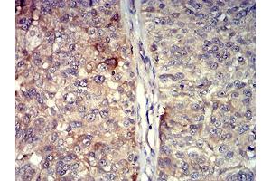 Immunohistochemical analysis of paraffin-embedded bladder cancer tissues using TNFSF11 mouse mAb with DAB staining.