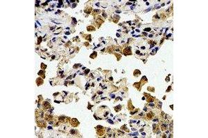 Immunohistochemical analysis of Cystatin A staining in human lung cancer formalin fixed paraffin embedded tissue section.
