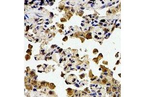 Immunohistochemical analysis of Cystatin A staining in human lung cancer formalin fixed paraffin embedded tissue section. (CSTA anticorps)