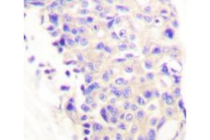 Immunohistochemistry analyzes of PLC γ1 antibody in paraffin-embedded human breast carcinoma tissue. (Phospholipase C gamma 1 anticorps)