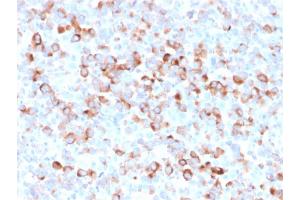 Formalin-fixed, paraffin-embedded Melanoma stained with Tyrosinase Mouse Recombinant Monoclonal Antibody (rOCA1/812). (Recombinant TYR anticorps)